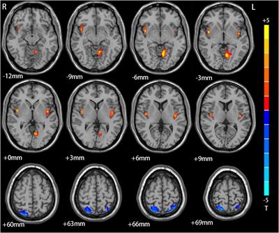 Abnormal degree centrality in first-episode medication-free adolescent depression at rest: A functional magnetic resonance imaging study and support vector machine analysis